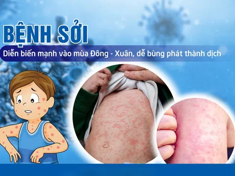 Trẻ em mắc sởi: Dinh dưỡng đúng cách giúp tăng sức đề kháng, đẩy lùi bệnh tật